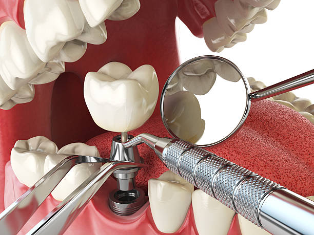 Best Emergency Tooth Extraction in Ponderay, ID